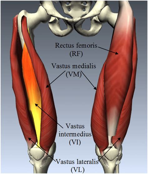 quadriceps femoral - hernia femoral